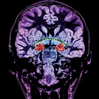 Cette image de scanner IRM montre en rouge les amygdales, des régions voisines de l’hippocampe. [unige]
