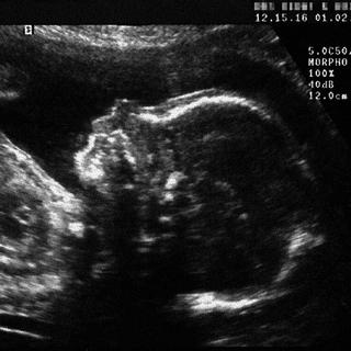 Echographie avortement IVG interruption grossesse [Didier Pallages]