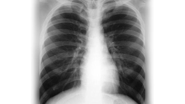 Radiographie de poumons touchés par la tuberculose.