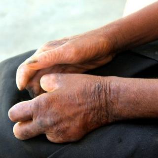 Les mains d'une femme malgache atteinte de lèpre, à Tuléar dans le sud de Madagascar, le 29 janvier 2011