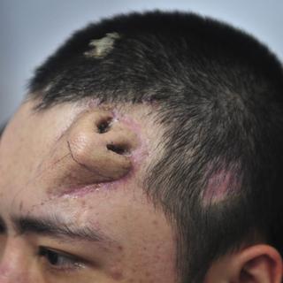 Un homme qui avait perdu son nez dans un accident s’est vu greffer un nez de substitution sur le front. [AP Photo]