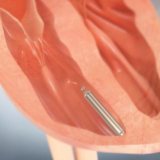 La capsule Nanostim© est vissée directement dans le muscle du ventricule. [St Jude Medical]