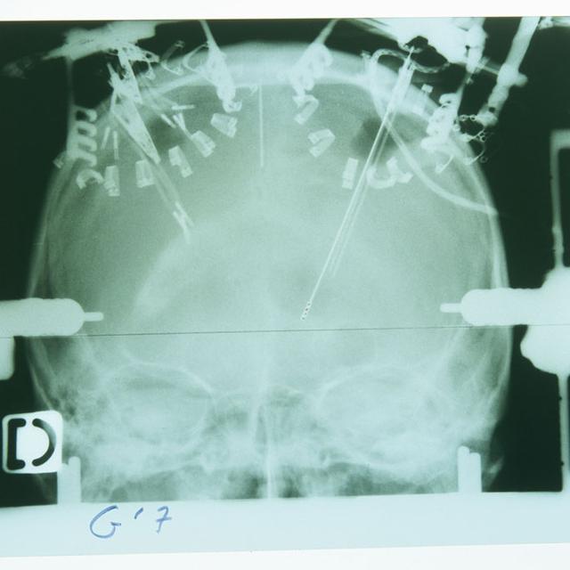 L'électrostimulation permettrait d'améliorer l'attention et la mémoire à très court terme. [ASTIER - CHRU LILLE / BSIP]