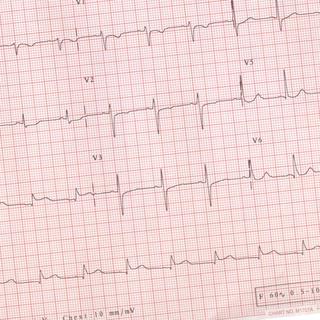 Électrocardiogramme montrant des signes d'infarctus du myocarde. [CC - BY - SA]