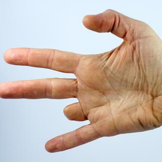 Main amputée d'un doigt. [pergo70]