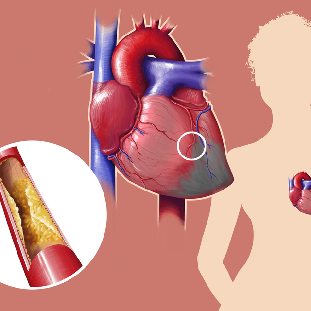 Chaque minute compte lors d'un infarctus du myocarde. [BSIP / AFP - Jeremy Catry]