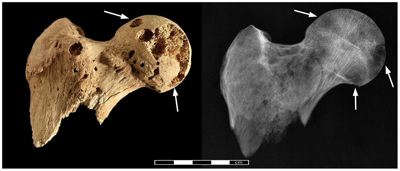 Les changements pathologiques constatés sur une tête de fémur d'un squelette masculin découvert en Egypte en mars 2014. [©2014 Binder et al.]