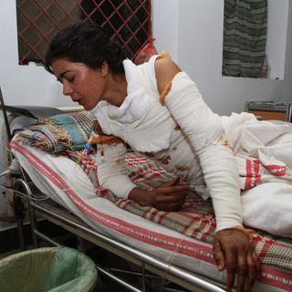 Jeune femme pakistanaise brûlée par un homme qu'elle avait refusé d'épouser. [AFP]
