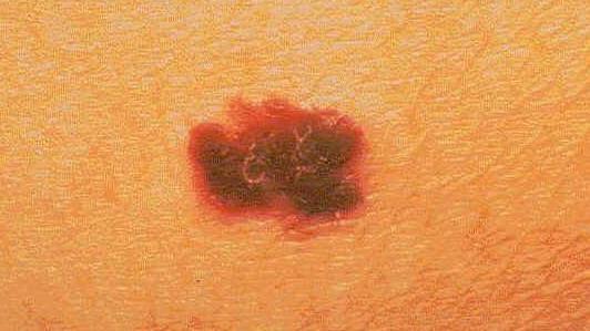 Le mélanome est une forme fortement agressive de cancer de la peau. [AP Photo/The American Cancer Society]