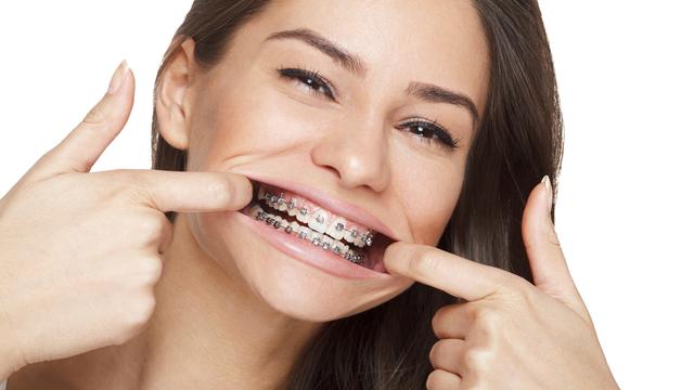 Femme adulte portant un appareil d'orthodontie. [Fotolia - djile]