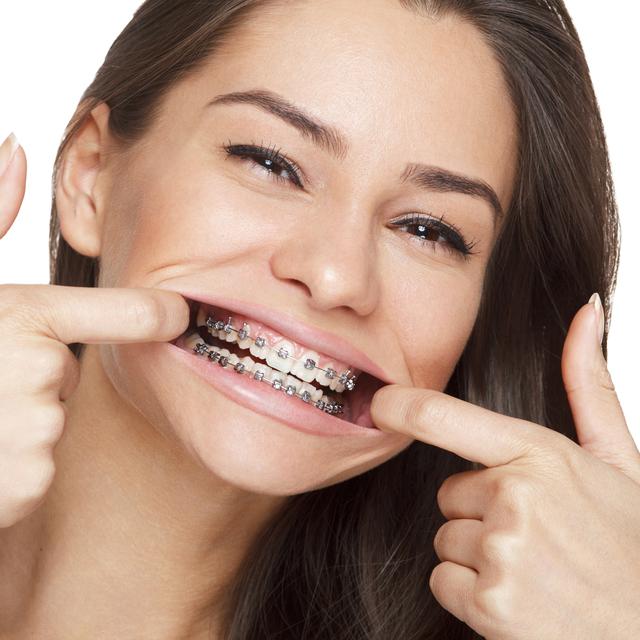 Femme adulte portant un appareil d'orthodontie. [Fotolia - djile]