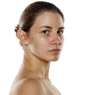 L'acné démarre à l'adolescence et peut se prolonger à l'âge adulte.
vladimirfloyd
Fotolia [vladimirfloyd]