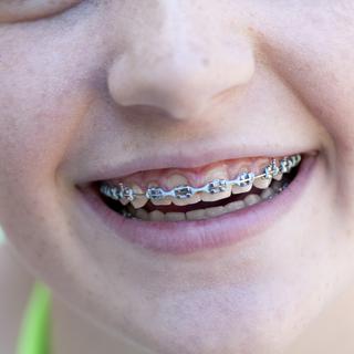 Une adolescente portant un appareil orthodontique. [Image Source - Raphael Buchler]