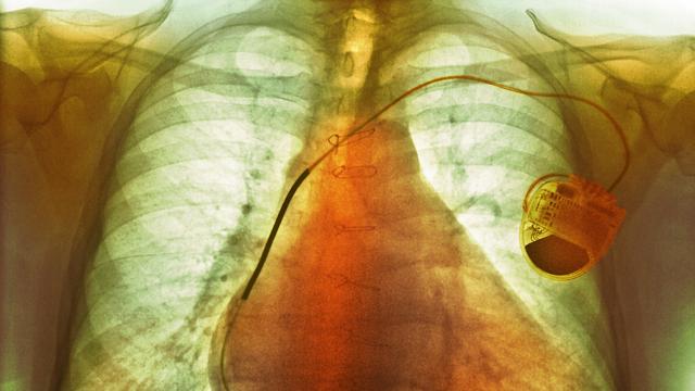 5000 personnes vivraient en Suisse avec un pacemaker potentiellement piratable (image d'illustration). [AFP]