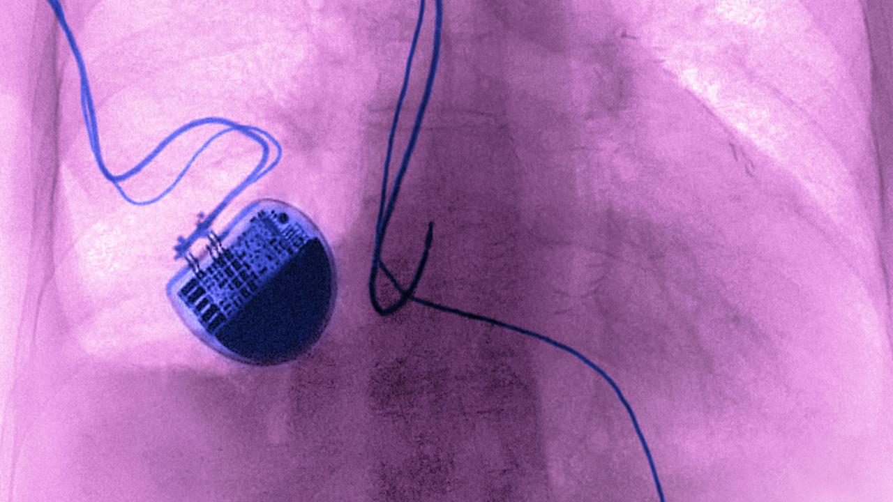 5000 personnes vivraient en Suisse avec un pacemaker potentiellement piratable (image d'illustration). [BSIP/AFP - James Cavallini]