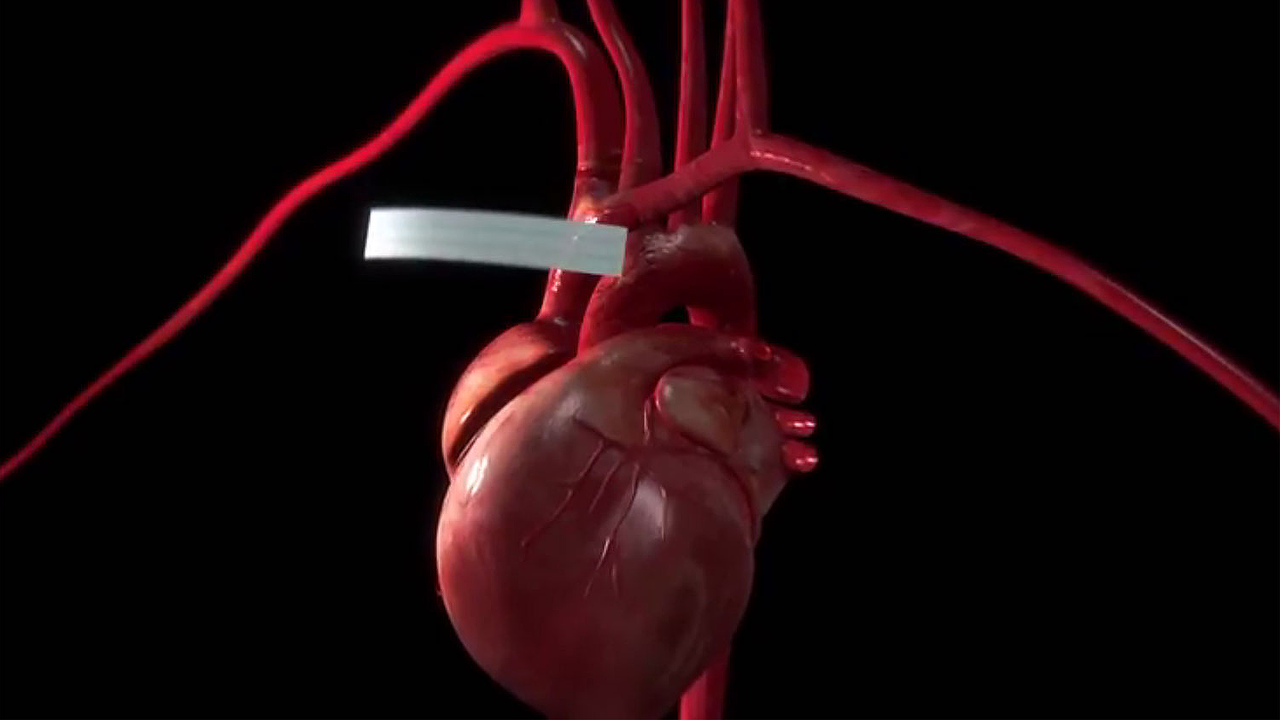Le centre va développer une sorte d'anneau autour de l’aorte, pour aider le coeur. [EPFL]