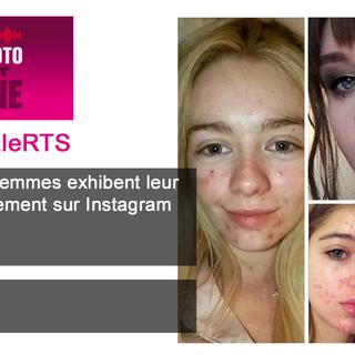 Des jeunes femmes exhibent leur acné positivement sur Instagram. [Instagram]