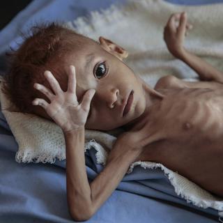 Un garçon souffrant de malnutrition sévère, hospitalisé dans un centre de soins à Hajjah au Yémen, photographié en octobre 2018. [AP/Keystone - Hani Mohammed]