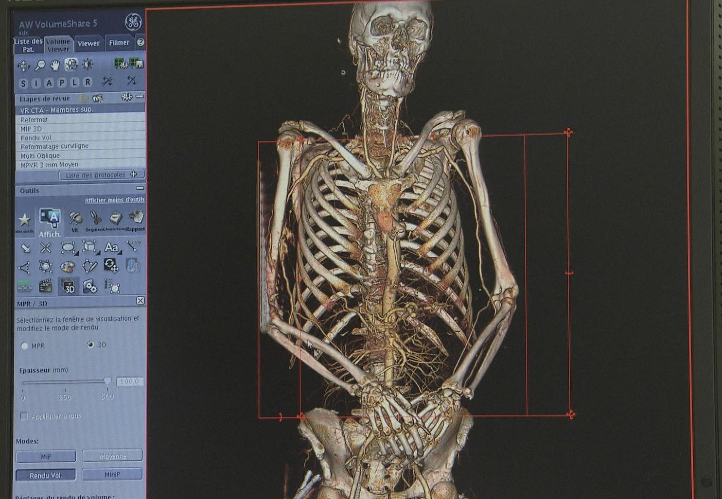 Une fois la peau "enlevée" par ordinateur, il est possible d'identifier uniquement les vaisseaux sanguins et le squelette, par exemple. [RTS]