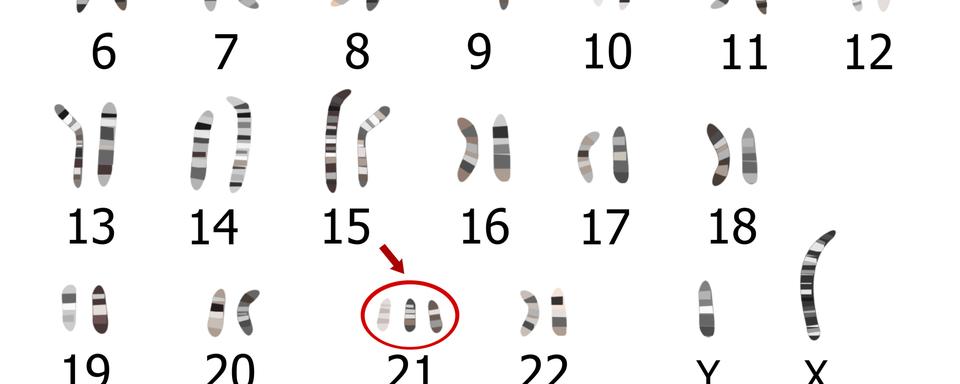 Le syndrome de Down se caractérise par la présence d'un chromosome surnuméraire.
zuzanaa
Depositphotos [Depositphotos - zuzanaa]