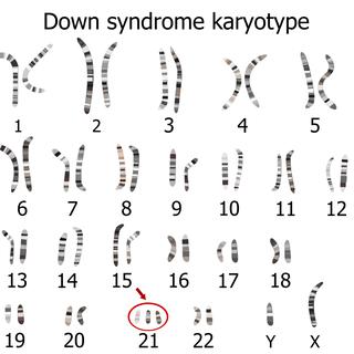 Le syndrome de Down se caractérise par la présence d'un chromosome surnuméraire.
zuzanaa
Depositphotos [Depositphotos - zuzanaa]