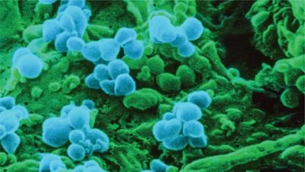 En bleu, le virus de la rougeole. Il attaque les cellules responsable de la "mémoire" immunitaire. [Science Source - NIBSC]