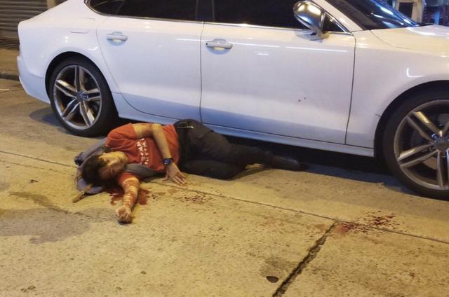 Le militant des Droits de l'Homme, Jimmy Sham tsk-kit, vient d'être attaqué par un inconnu armé d'un marteau. Le jeune homme de 32 ans a été hospitalisé. Hong Kong, le 16 octobre 2019. [afp - EyePress News]