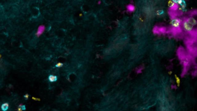 Cette image montre une coloration des lymphocytes T (cyan) exprimant la chimiokine CCL5 (jaune) - appelant les cellules auto-réactives-, qui résident sur un site d’infection virale résolu (rose).
Doron Merkler
Unige [Unige - Doron Merkler]