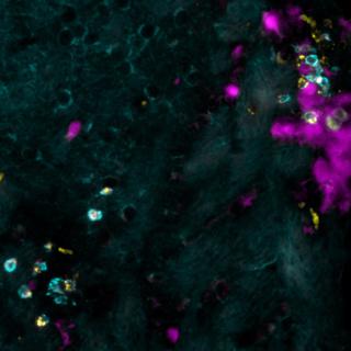 Cette image montre une coloration des lymphocytes T (cyan) exprimant la chimiokine CCL5 (jaune) - appelant les cellules auto-réactives-, qui résident sur un site d’infection virale résolu (rose).
Doron Merkler
Unige [Unige - Doron Merkler]