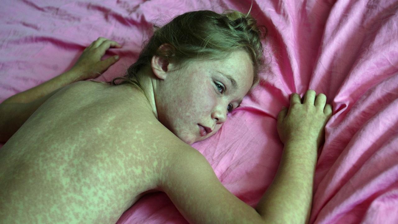 Une jeune fille touchée par la rougeole (image d'illustration). [Keystone - Urs Flueeler]