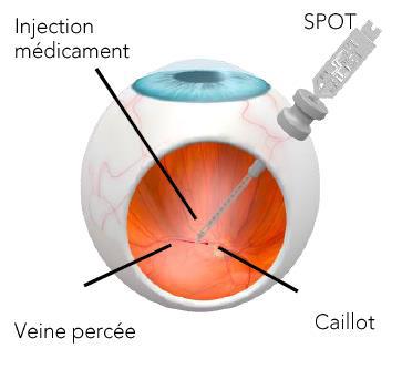 L'aiguille en verre doit permettre d'atteindre la rétine sur la face interne de l'oeil et ses petites veines. [EPHJ]