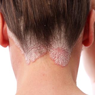 Une nouvelle consultation au CHUV pour apprendre à vivre avec le psoriasis. [Depositphotos - Farina6000]