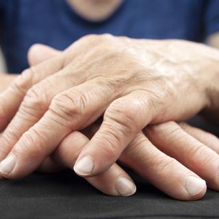 Mains de femme déformées par la polyarthrite rhumatoïde.
Hriana
depositphotos [Hriana]