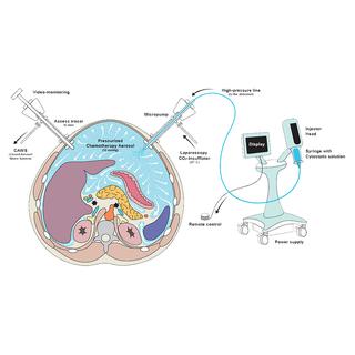 Schéma de la procédure PIPAC, la chimiothérapie intrapéritonéale préssurisée par aérosols.
CHUV [CHUV]