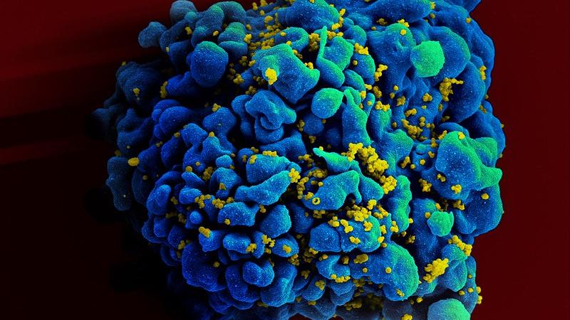 Une cellule T infectée par le VIH. [National Institute of Health (NIH)]