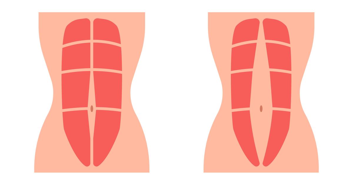 Le diastasis des grands droits un écart de conduite?