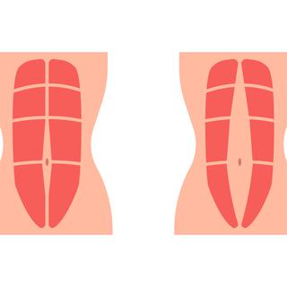 Le diastasis est un écartement des muscles abdominaux.
Fagreia
Depositphotos [Fagreia]