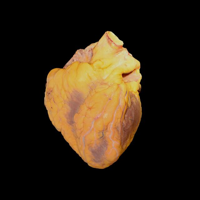 Autopsie d'un coeur humain. [Wikimedia Commons / domaine public - Jebulon]