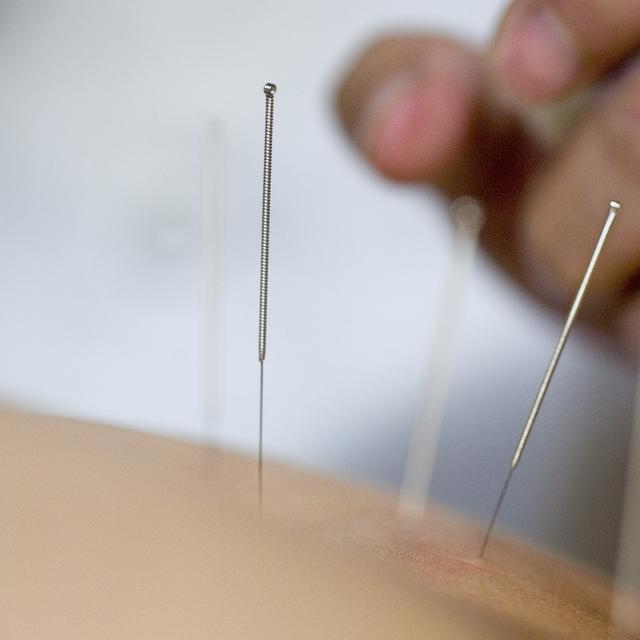 Des aiguilles d'acupuncture sont insérées dans les points d'acupuncture d'un patient dans le cabinet médical MediQi pour la médecine traditionnelle chinoise (MTC) à Zurich, en Suisse, photographié le 18 octobre 2007. [KEYSTONE - Gaetan Bally]