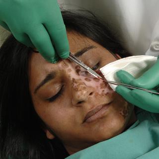 La dépigmentation volontaire de la peau connaît un essor mondial [Keystone - Maria Platt-Evans]
