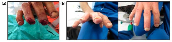 (a) Des doigts amputés avant l'application d'un pansement isolant. (b) Trois mois après l'amputation lors d'une évaluation clinique et morphologique. [CC BY - Licensee MDPI, Basel, Switzerland]