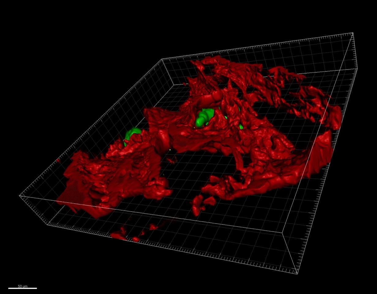 Image en 3D montrant l'invasion de cellules de cancer du sein (en vert) exprimant ZEB1 dans un tissu osseux de souris (en rouge). [UNIGE - Didier Picard]