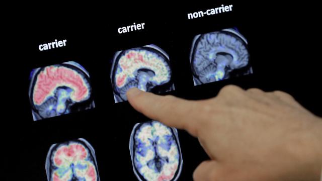 Il y a un besoin urgent d'outils de diagnostic simples et bon marché pour améliorer le dépistage précoce d'Alzheimer. [AP/Keystone - Matt York]