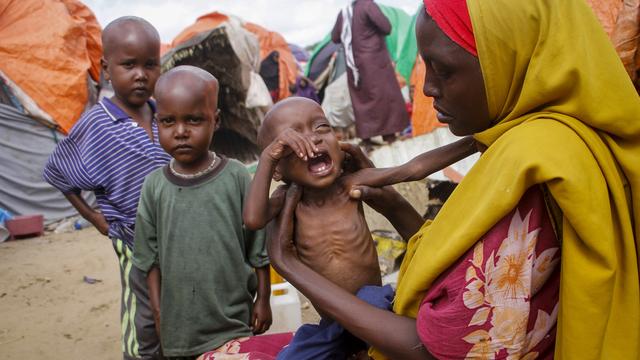 La malnutrition en Somalie touche tout particulièrement les enfants de moins de cinq ans. [AP/Keystone - Farah Abdi Warsameh]