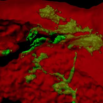 Image en 3D montrant l’invasion de cellules de cancer du sein (en vert) exprimant ZEB1 dans un tissu osseux de souris (en rouge). [UNIGE - Didier Picard]