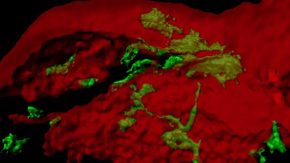 Image en 3D montrant l’invasion de cellules de cancer du sein (en vert) exprimant ZEB1 dans un tissu osseux de souris (en rouge). [UNIGE - Didier Picard]