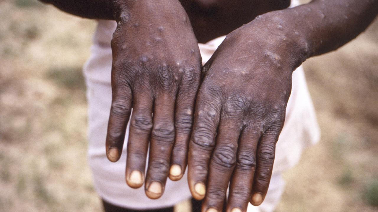 Les symptômes de la "variole du singe" sont proches de ceux de la variole, en moins virulent (image d'archive). [CDC via AP/Keystone]