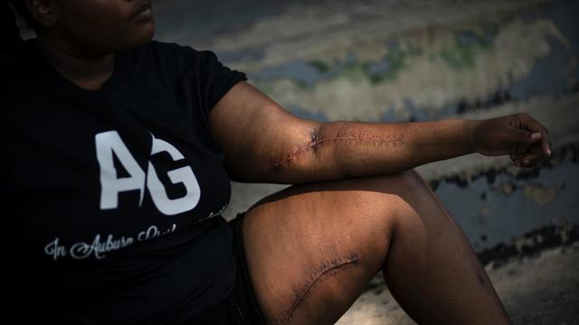 Teyonna Lofton, 18 ans, montre les cicatrices laissées sur sa peau. Elle a dû être opérée après s'être retrouvée au milieu d'une fusillade. Chicago, août 2020. [Keystone / AP photo - David Goldman]