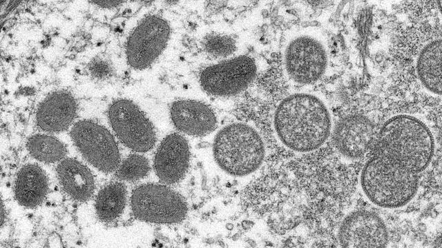 Des cas de variole de singe en Europe [REUTERS - THIRD PARTY]