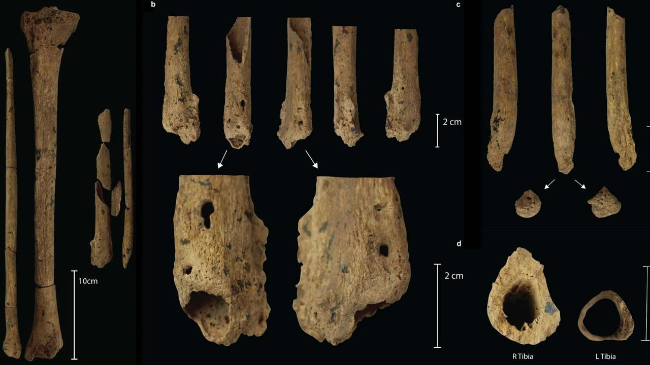 (a) Comparaison des tibias et des péronés gauche et droit. (b) Tibia gauche montrant les surfaces d'amputation cicatrisées du site d'amputation. (c) Péroné gauche montrant les surfaces d'amputation cicatrisées du site d'amputation. (d) L'épaisseur du cortex du tibia gauche et droit est présentée pour comparaison, démontrant l'atrophie du membre inférieur gauche en association avec l'amputation. [Nature - Tim Ryan Maloney et al.]